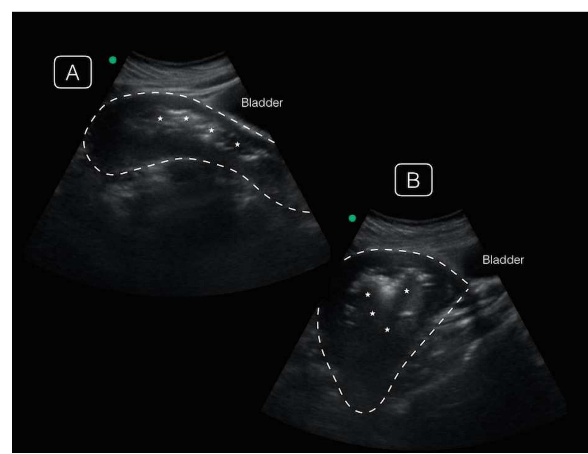 Image. Point-of-care ultrasonographic transabdominal images of the uterus in midline (A) and off-axis sagittal views (B), demonstrating an enlarged uterus (dotted line) with irregular echogenic endometrial debris (asterisk) casting shadows from the endometrium.  Video. Transabdominal ultrasound of the uterus with debris and air with shadowing artifact. 