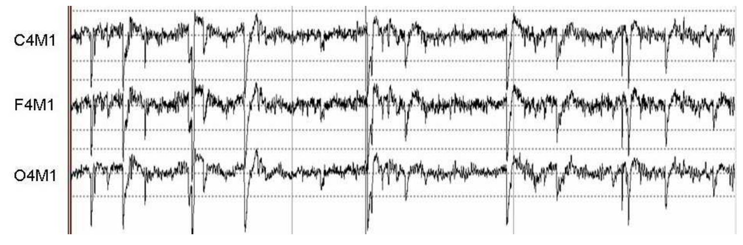 Figure 4 Electrode pops in EEG (see online version for colours) 