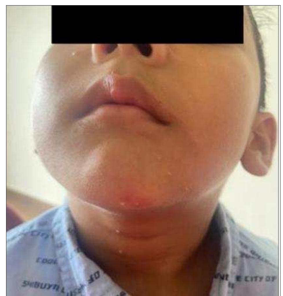 Fig 1: (Before Treatment)  IWLOMUSCUTT COMtLdSIOSuT Is d MeGiCdal CONCCHITT Hl Ady lO Ady clinical practice. It is also called water warts caused by MCV. People frequently go for the treatment of MC mainly due to cosmetic reason and to avoid social stigma or because they have the concern of transmission to other individual. It is a self-limiting disease but takes several months to cure. Conventional treatment of MC includes physical removal of mollusca, use of ointment. By the help of cryotherapy mollusca can be removed locally but it is very painful. A safe alternative way to physical removal is use of cimetidine in children who fear pain, but a recent meta-analysis did not show any difference with cimetidine. So, Homoeopathy can be a better option than the common conventional way of treatment. In this case after careful recording of the present complains, medical history with Boericke’s repertory reference, medicine was prescribed. In the Boericke’s repertory, Bromium is 1“ graded medicine for MC. After prescription of Bromium 30C/4 dose/ BD for 2 days, slight aggravation of respiratory symptoms was noticed by parents, which proved the correct selection of the medicine. There was a marked improvement in main complains and general symptoms were noticed in 20-30 days after taking the prescribed medicine. In this case we treated MC with homoeopathic medicine for not only relief the sign and symptom but also assured no recurrence was reported for more than 3 months of follow up. This case shows effective role of homoeopathic medicine which were mentioned in Boericke’s repertory.  