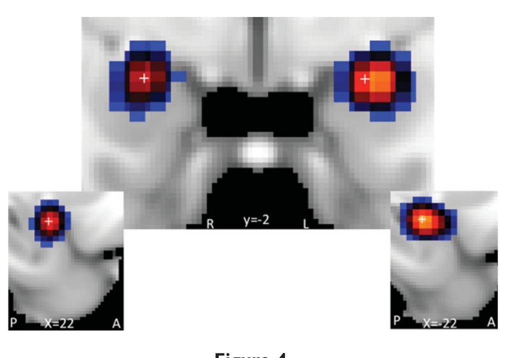 Amygdala activation in clinical pain subjects. Increased signal clin- ical pain activation from GingerALE analysis. Top images are cor- onal views, bottom images are sagittal. A = anterior, L = left, P  = posterior, R = right. [Color figure can be viewed in the online issue, which is available at wileyonlinelibrary.com.] 