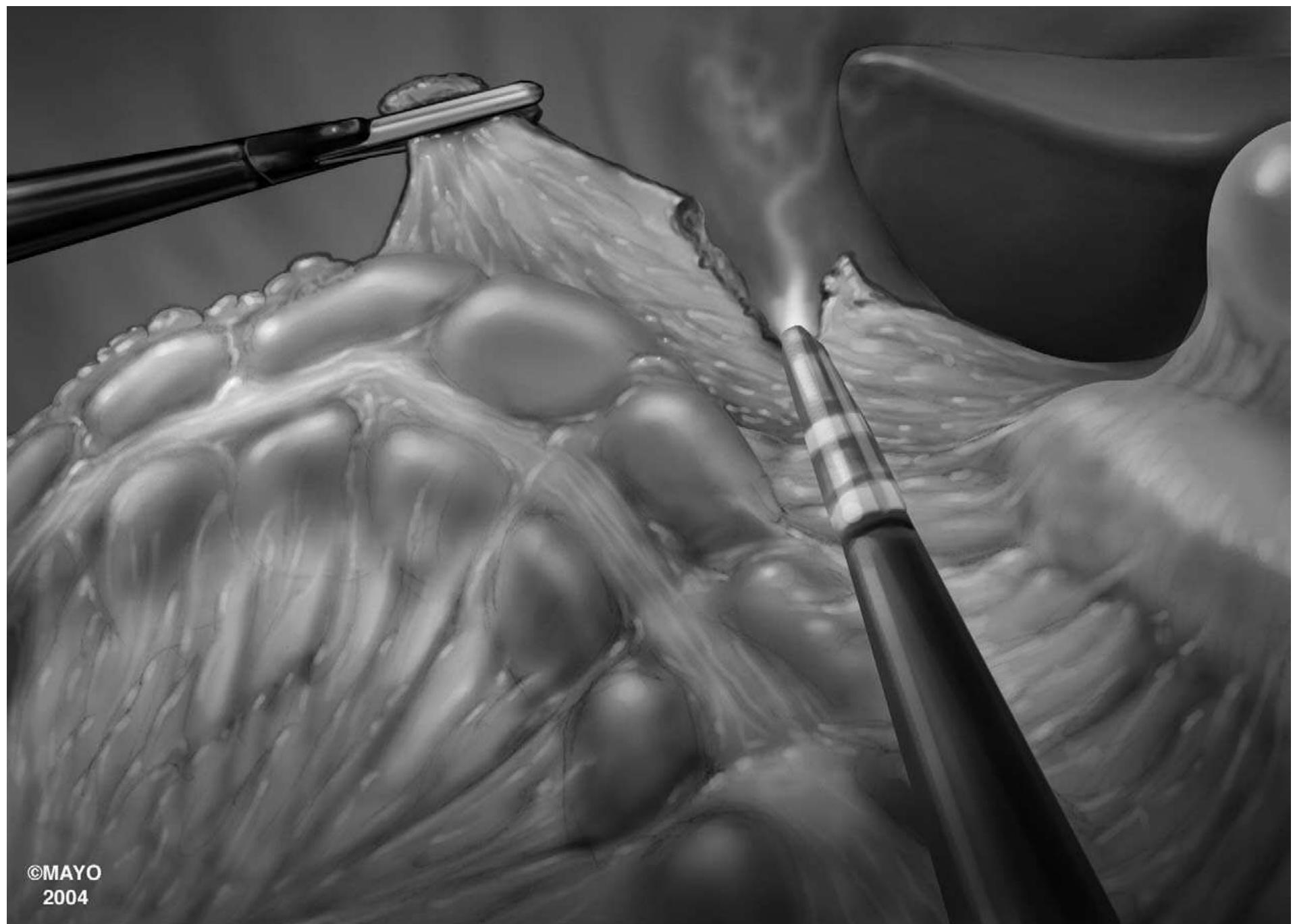 Figure 6 To mobilize the hepatic flexure, the patient is placed in reverse Trendelenburg, with the right side still tilted up, exposing the hepatic flexure. The gastrocolic attachments are grasped close to but not on the bowel and elevated obliquely toward the lower anterior abdominal wall. The tissue can often be seen moving over the underlying plane between the gastrocolic attachments and the retroperitoneum, allowing identification and entry into the correct plane. The duodenum must again be identified and protected. The hepatic flexure should be mobilized sufficiently to be brought down to the level of the umbilicus. If the camera, when focused on the mobilized hepatic flexure, is angled below an imaginary transverse line drawn through the umbilicus, the flexure has been mobilized sufficiently to permit exteriorization. A final check is made by pulling the mobilized right colon over to the left side of the abdomen to ensure that the entire right retroperitoneum is free of residual attachments. 