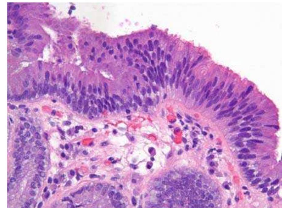 Fig. 15.3 Barrett’s esophagus with low grade dysplasia. Barrett’s mucosa showing glands with mild architectural distor- tion and gland lined by cells containing elongated (cigar shaped) and stratified nuclei which still retain nuclear polarity 