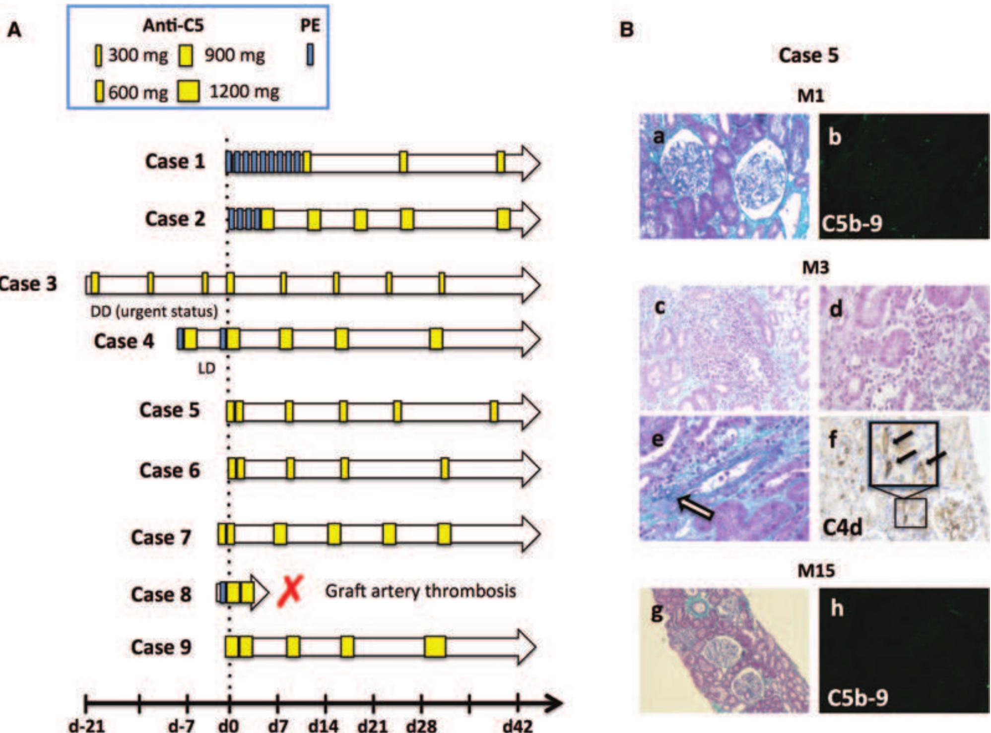 Figure 1: Prophylactic anti-C5 therapy. (A) The prophylactic eculizumab regimens depicted here represent those used to prevent aHUS recurrence in the study population. (B) Light microscopy and immunofluorescence analysis of graft biopsies performed in case 5. Although an early 1-month biopsy displayed normal renal parenchyma (a), the 3-month posttransplant biopsy disclosed severe mixed acute rejection, following a prolonged discontinuation of mycophenolic acid due to neutropenia. The complete histological pattern included interstitial inflammation, tubulitis (c), endothelitis, and transmural necrosis of a small artery (e, white arrow), surrounded by perivascular infiltrate, associated with hallmark lesions of antibody-mediated rejection, including glomerular and peritubular capillaritis (d) and mild C4d staining (f, black arrow). The biopsy performed 12 months later demonstrated a complete recovery from severe rejection (g). Remarkably, none of these biopsies displayed any signs of thrombotic microangiopathy. Consistently, negative C5b-9 staining indicated efficient and sustained in situ C5 blockade throughout the follow-up period (b, h). Anti-C5 = eculizumab; DD = deceased donor; LD = living donor; PE = plasma exchanges. 