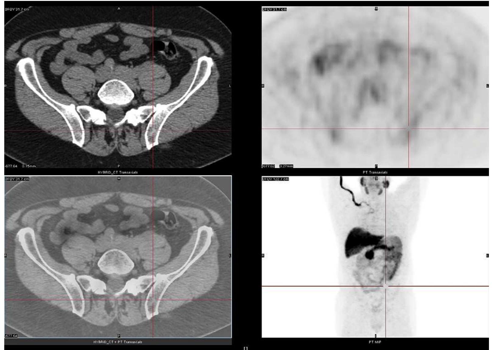 Fig. 9. Case 3. [''C]acetate-PET/CTAC scan performed after external beam radiation and hormone therapy) showing resolution of abnormal [''C]acetate metabolism in the left iliac spine. 