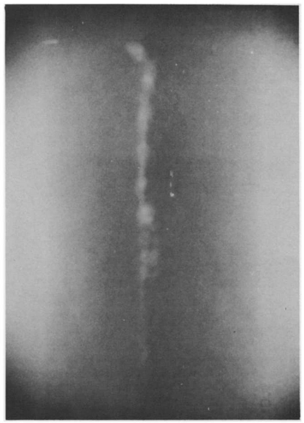 Fig.2 Areal-time X-ray image of an aluminium weld, with a defect of incomplete penetration. The image was taken with a geometrical magnification of 10 
