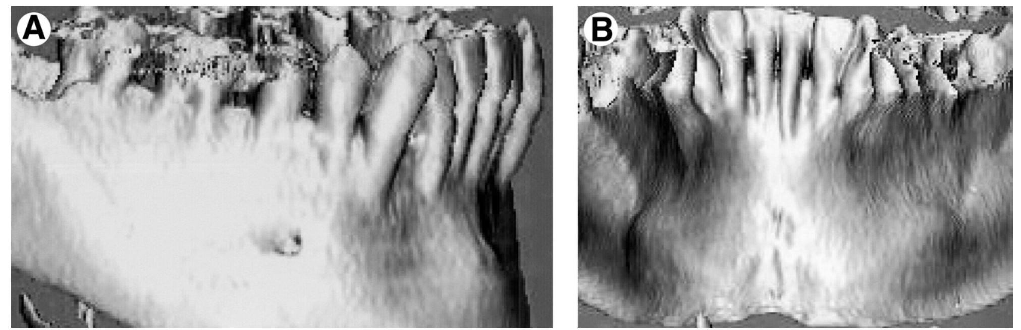 FIGURE 4. Patient 1. A, Pretreatment surface computed tomographic scan, right oblique view of lower arch. B, Pretreatment surface computed tomographic scan, lingual view of lower arch. 