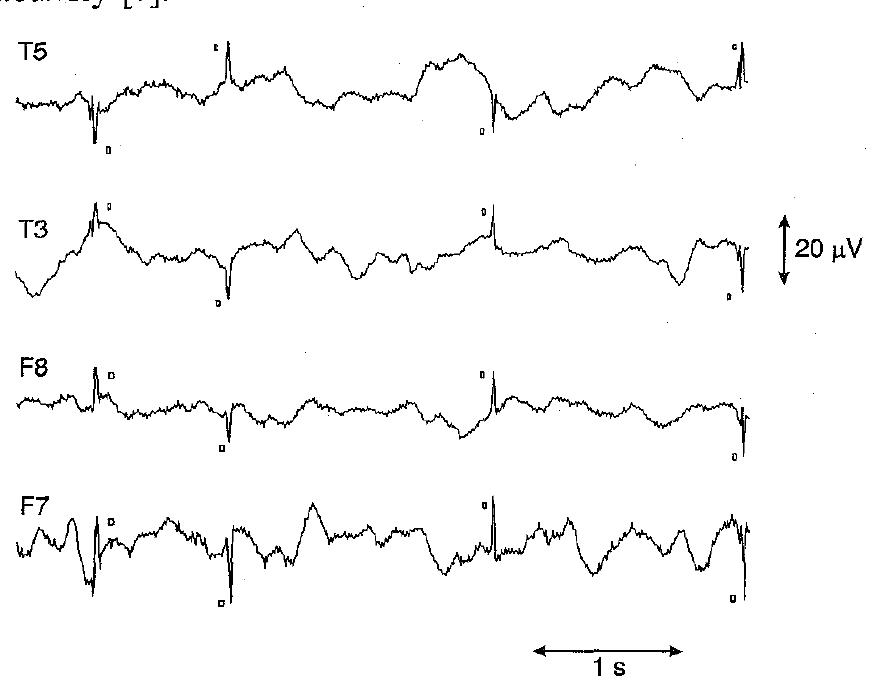 In this paper, we extend our work on the neural net- work analysis of the EEG to consider the detection of inter-ictal spikes in epileptic patients. Epilepsy does not refer to a specific disease, but rather to a group of symptoms due to varied causes. It is defined as a chronic brain disorder of various aetiologies character- ised by recurrent seizures (ictal disturbances) due to excessive discharge of cerebral neurons. Between sei- zures, the EEG of subjects who suffer from epilepsy is usually characterised by occasional inter-ictal activity in the form of spikes or spike and wave complexes. When the EEG is recorded in the investigation of epi- lepsy, it is almost always an inter-ictal recording which is made. Occasionally, a seizure may also occur by chance during the recording but, in the majority of instances when epilepsy is confirmed by analysis of the EEG, it is on the basis of inter-ictal rather than ictal activity [7].  Fig.1 Inter-ictal spikes (shown with rectangles) from one of the EEG recordings analysed in this paper  A. spike, as shown in Fig. 1, is a sudden burst of electrical activity, lasting for up to 70ms, in an otherwise normal background. A sharp wave is simply a spike of longer duration, usually between 70 and 200ms. Spikes and sharp waves are sometimes followed by a slower wave, hence the description of ‘spike and wave complex’. 