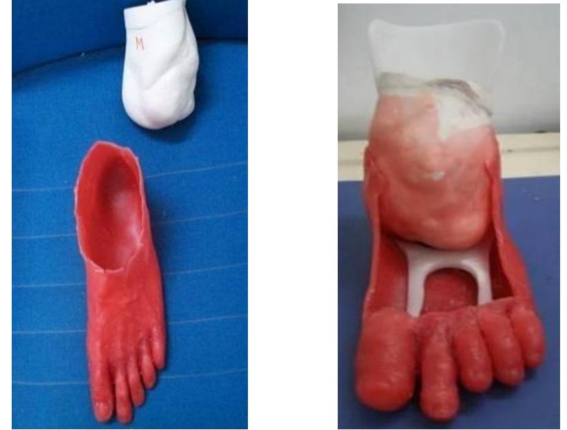 Figure 1: Cast of amputated limb and replica of sound side foot Figure 2: AFO placed inside the foot Figure 3: Patient with wax moulded partial foot prosthesis 