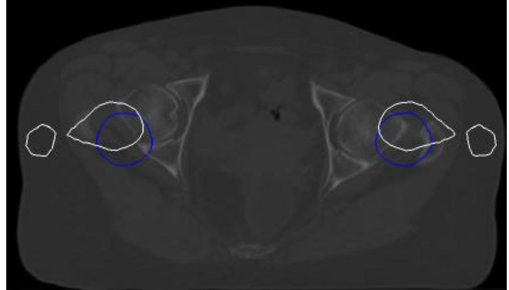 Fig 2:Case of the cut through the physically (blue shading) and naturally (white shading) situated femur model.  Vol. 7, Issue 11, November 2019 